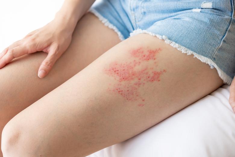 imagem de alergia na perna para ilustrar conteúdo sobre alergia a medicamentos